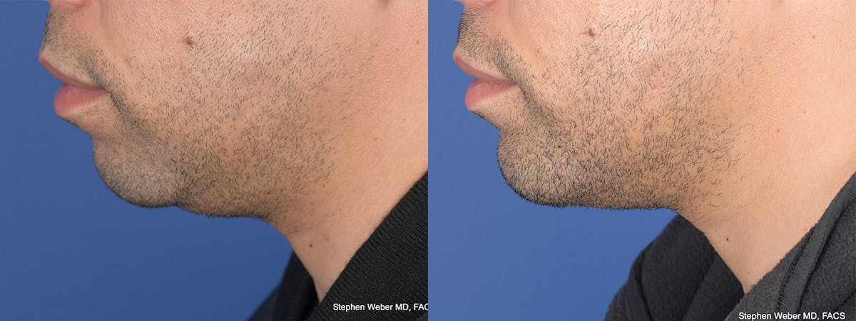 Chin Implant Before & After Gallery - Patient 128884 - Image 2