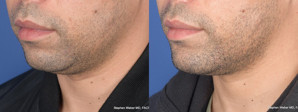 Chin Implant Before & After Gallery - Patient 128884 - Image 3
