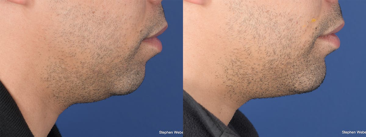 Chin Implant Before & After Gallery - Patient 128884 - Image 4