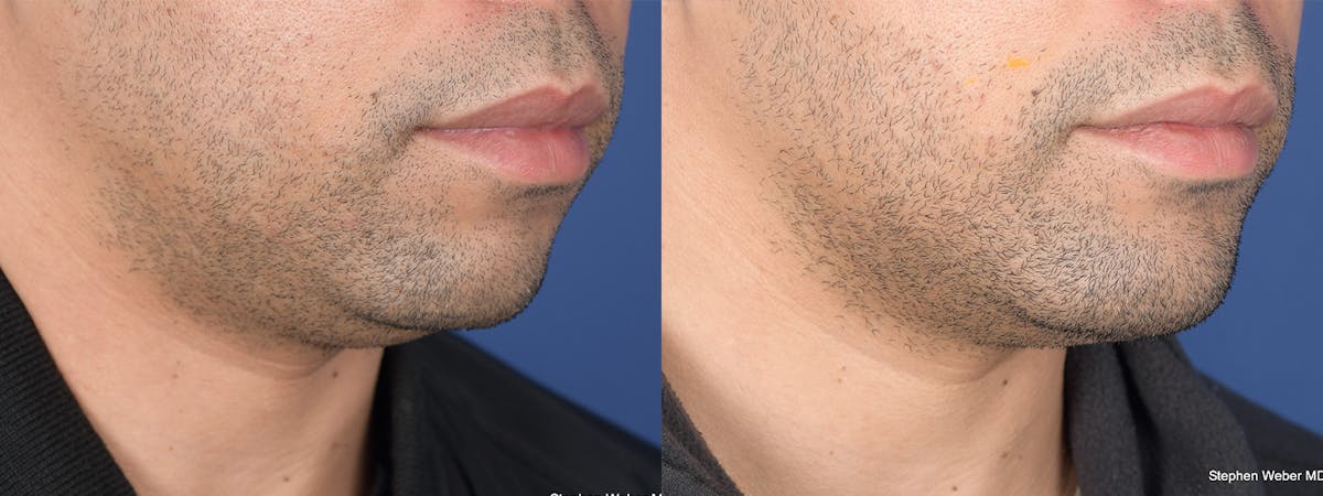 Chin Implant Before & After Gallery - Patient 128884 - Image 5