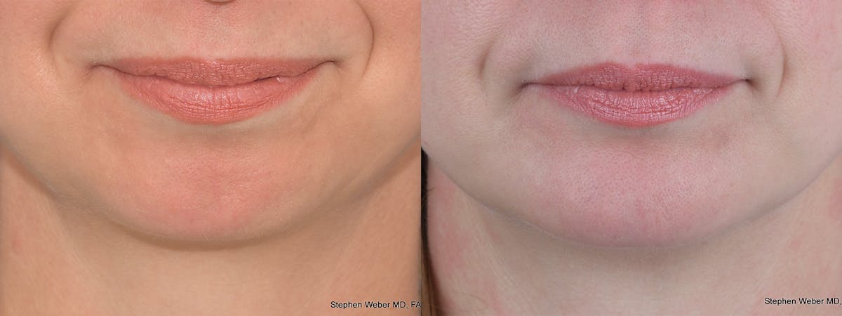 Chin Implant Before & After Gallery - Patient 237928 - Image 1