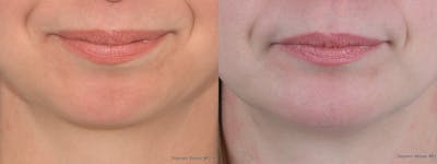 Chin Implant Before & After Gallery - Patient 237928 - Image 1
