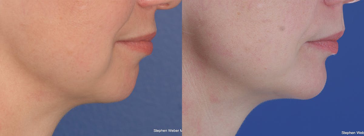 Chin Implant Before & After Gallery - Patient 237928 - Image 2
