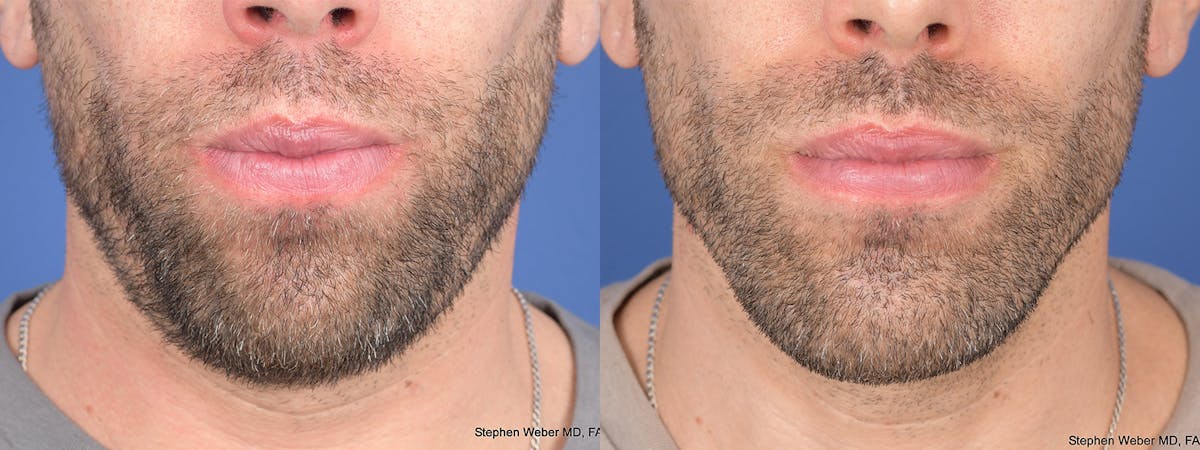 Chin Implant Before & After Gallery - Patient 114982 - Image 1
