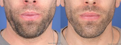Chin Implant Before & After Gallery - Patient 114982 - Image 1