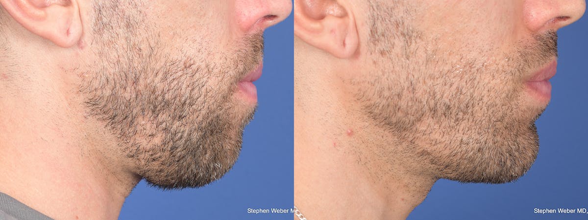 Chin Implant Before & After Gallery - Patient 114982 - Image 2