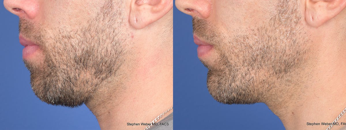 Chin Implant Before & After Gallery - Patient 114982 - Image 3