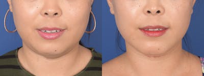 Chin Implant Before & After Gallery - Patient 373731 - Image 1
