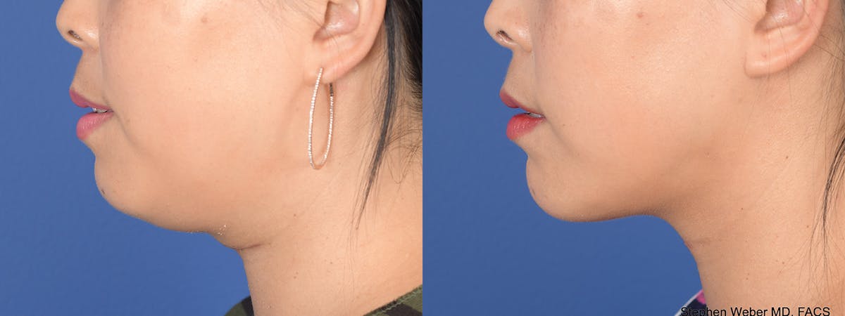Chin Implant Before & After Gallery - Patient 373731 - Image 2