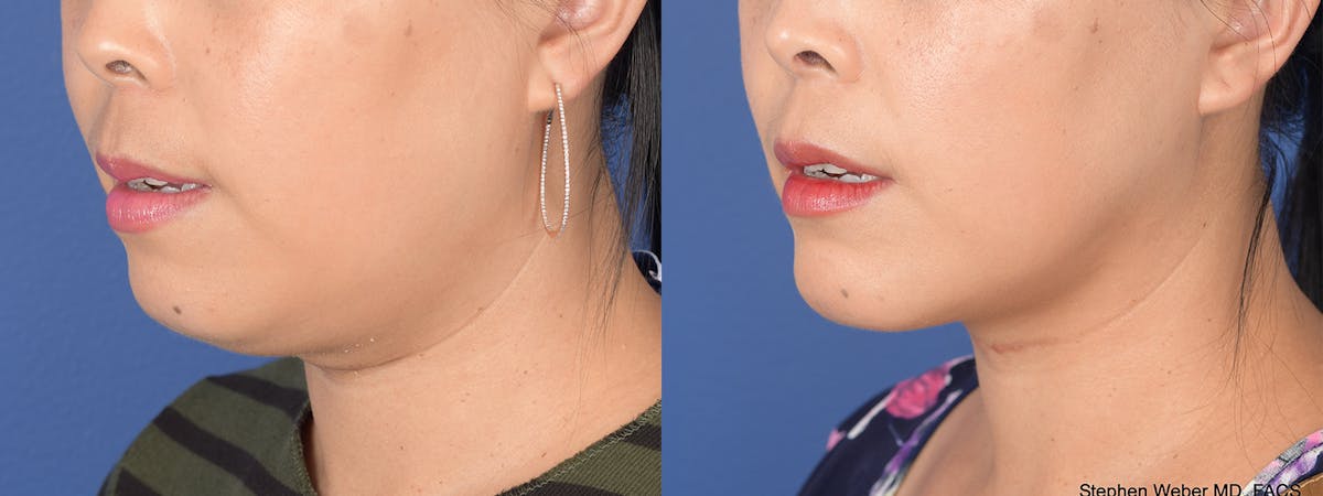 Chin Implant Before & After Gallery - Patient 373731 - Image 3