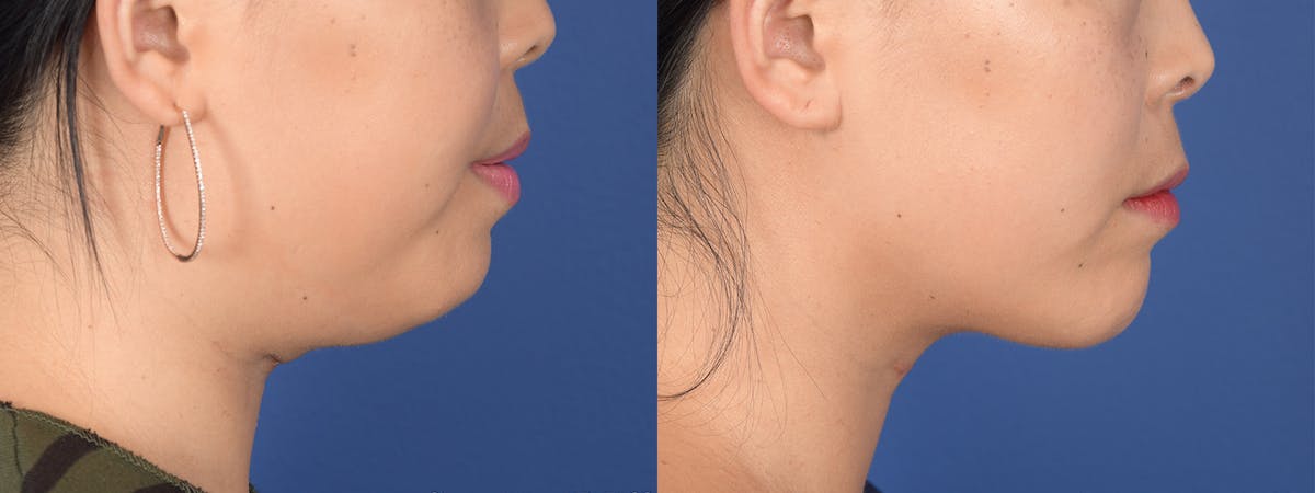 Chin Implant Before & After Gallery - Patient 373731 - Image 4