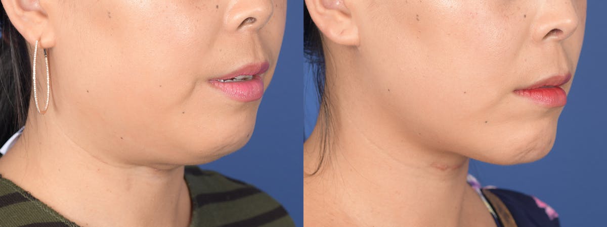 Chin Implant Before & After Gallery - Patient 373731 - Image 5
