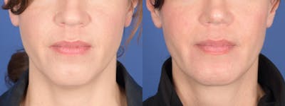 Chin Implant Before & After Gallery - Patient 253731 - Image 1