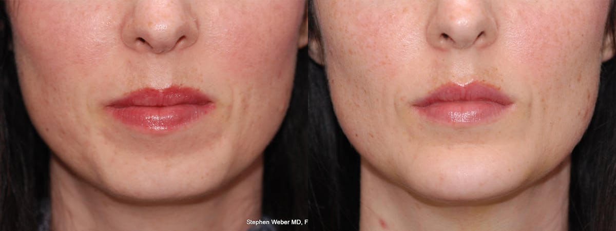 Chin Implant Before & After Gallery - Patient 557931 - Image 1