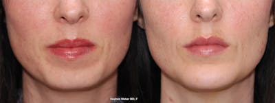 Chin Implant Before & After Gallery - Patient 557931 - Image 1