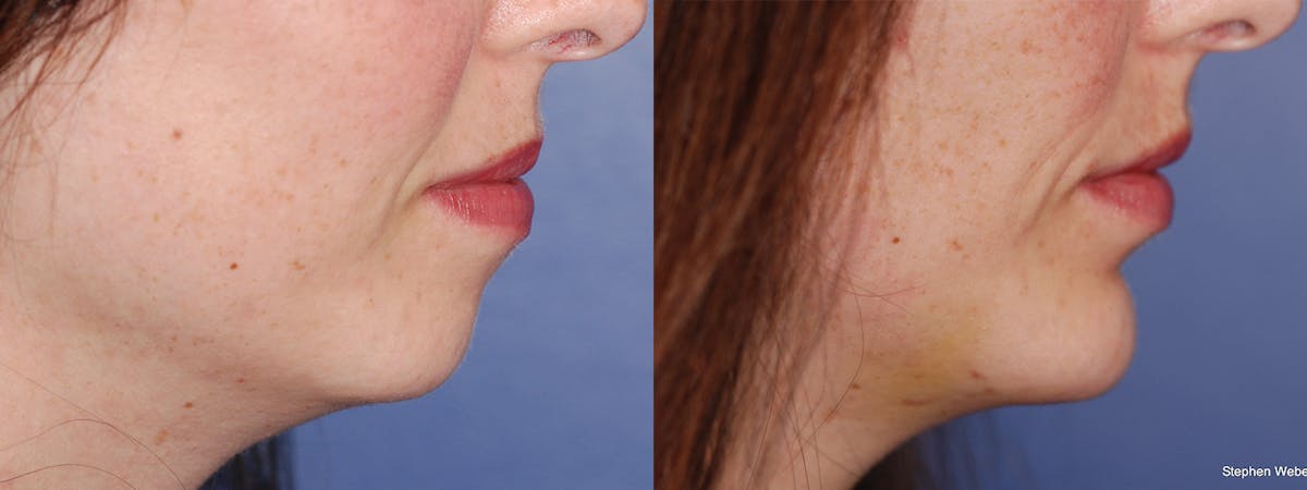 Chin Implant Before & After Gallery - Patient 557931 - Image 2
