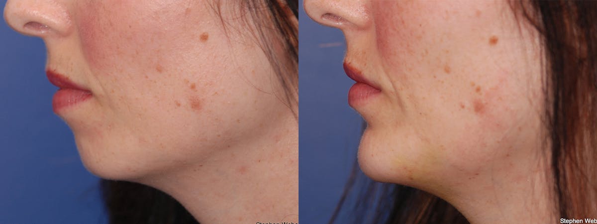 Chin Implant Before & After Gallery - Patient 557931 - Image 3