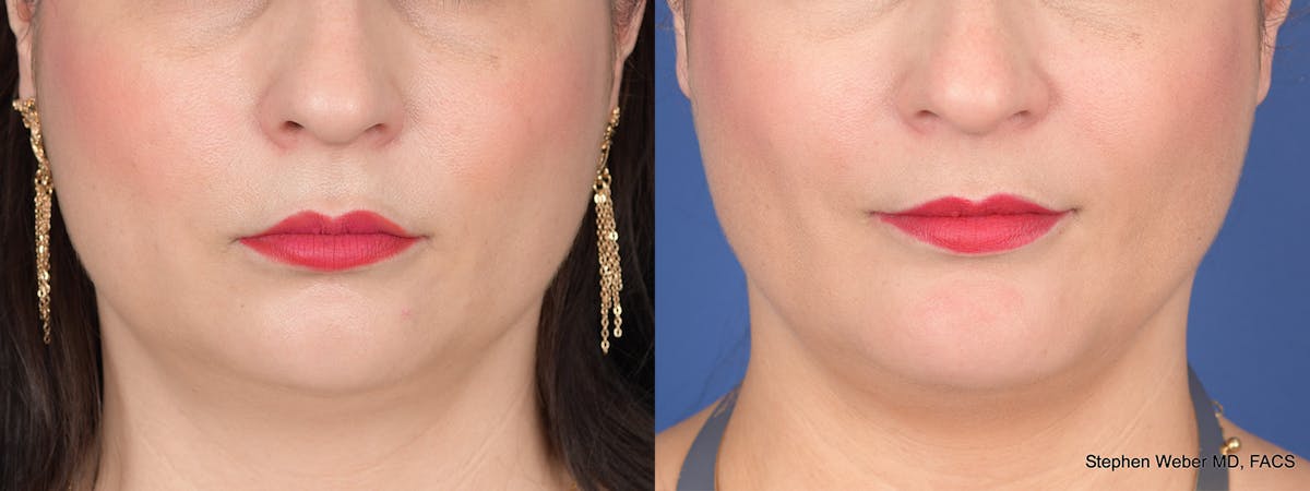 Chin Implant Before & After Gallery - Patient 739602 - Image 1