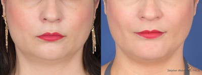 Chin Implant Before & After Gallery - Patient 739602 - Image 1