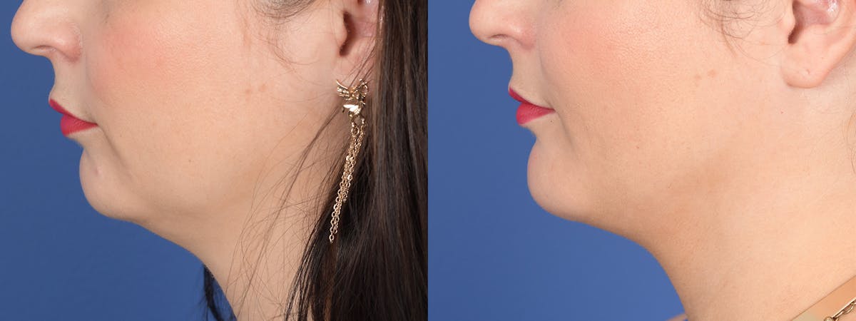 Chin Implant Before & After Gallery - Patient 739602 - Image 2