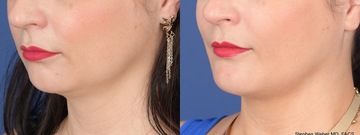 Chin Implant Before & After Gallery - Patient 739602 - Image 3