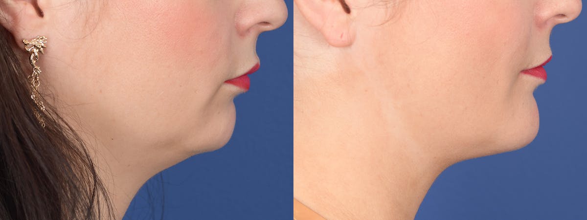 Chin Implant Before & After Gallery - Patient 739602 - Image 4