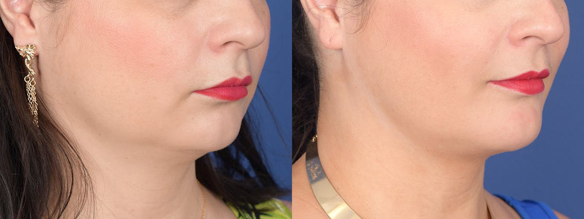 Chin Implant Before & After Gallery - Patient 739602 - Image 5