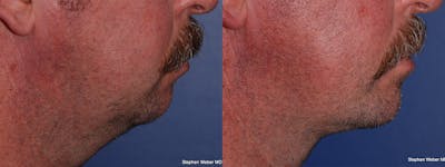 Chin Implant Before & After Gallery - Patient 422108 - Image 1