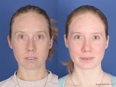 Rhinoplasty Before & After Gallery - Patient 103257 - Image 1