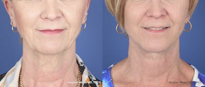 Chin Implant Before & After Gallery - Patient 212449 - Image 1