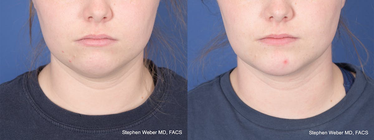 Chin Implant Before & After Gallery - Patient 310293 - Image 1