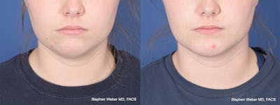 Chin Implant Before & After Gallery - Patient 310293 - Image 1