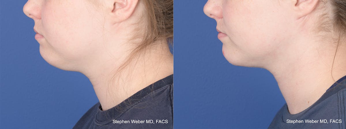 Chin Implant Before & After Gallery - Patient 310293 - Image 2