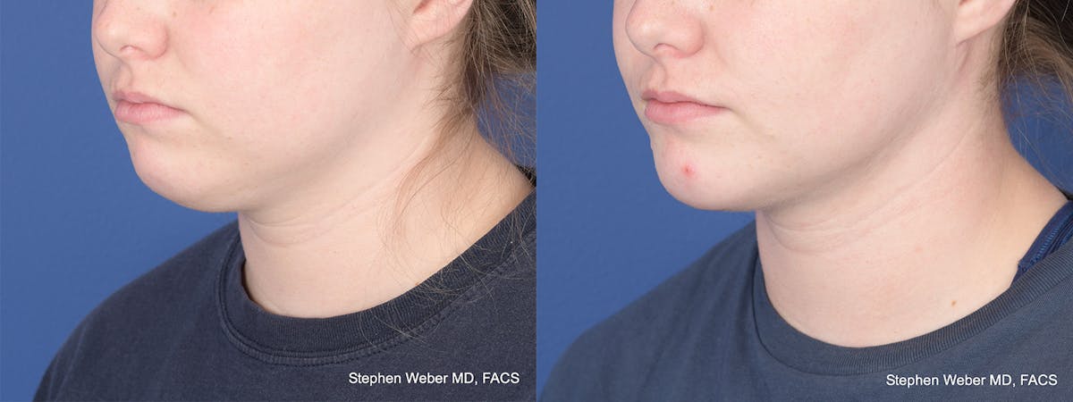 Chin Implant Before & After Gallery - Patient 310293 - Image 3