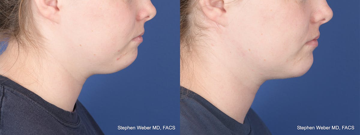 Chin Implant Before & After Gallery - Patient 310293 - Image 4
