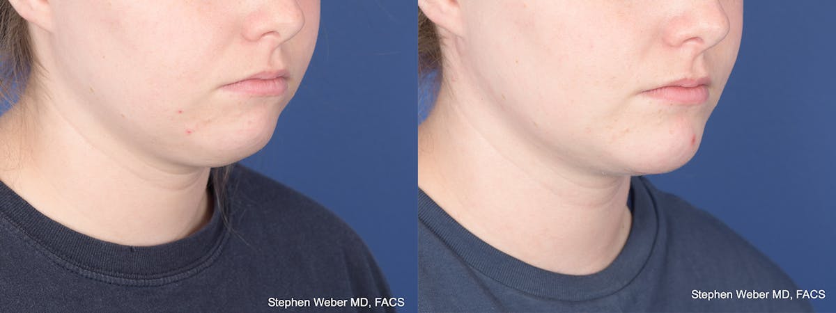Chin Implant Before & After Gallery - Patient 310293 - Image 5
