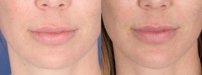 Chin Implant Before & After Gallery - Patient 120092 - Image 1