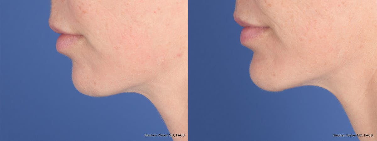 Chin Implant Before & After Gallery - Patient 120092 - Image 2