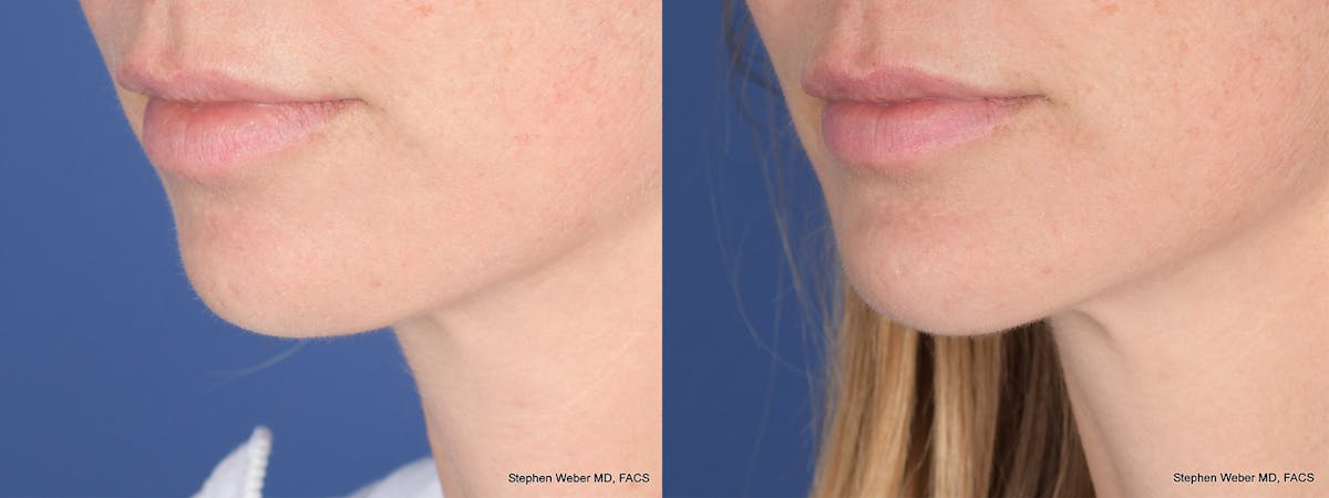 Chin Implant Before & After Gallery - Patient 120092 - Image 3
