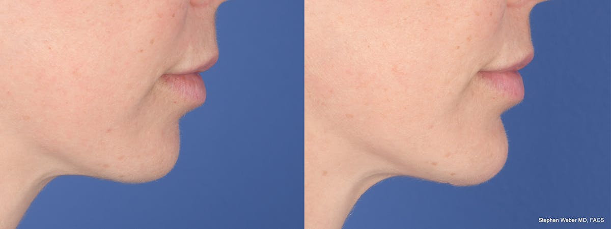 Chin Implant Before & After Gallery - Patient 120092 - Image 4