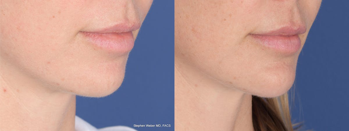 Chin Implant Before & After Gallery - Patient 120092 - Image 5