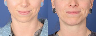 Chin Implant Before & After Gallery - Patient 268704 - Image 1