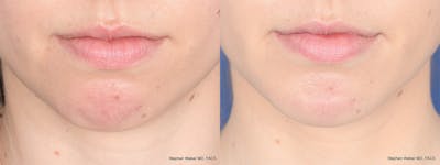 Chin Implant Before & After Gallery - Patient 312010 - Image 1