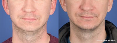 Chin Implant Before & After Gallery - Patient 421135 - Image 1