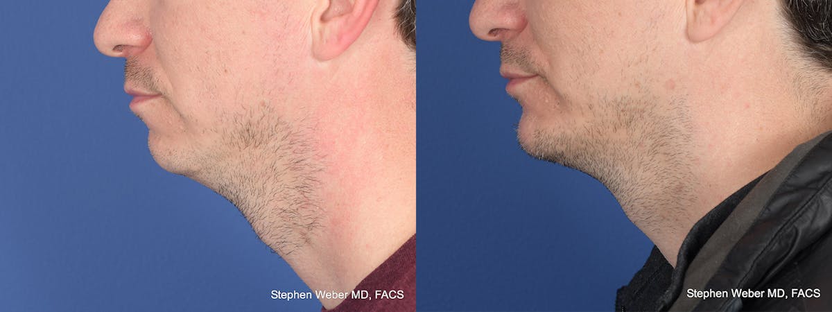 Chin Implant Before & After Gallery - Patient 421135 - Image 2