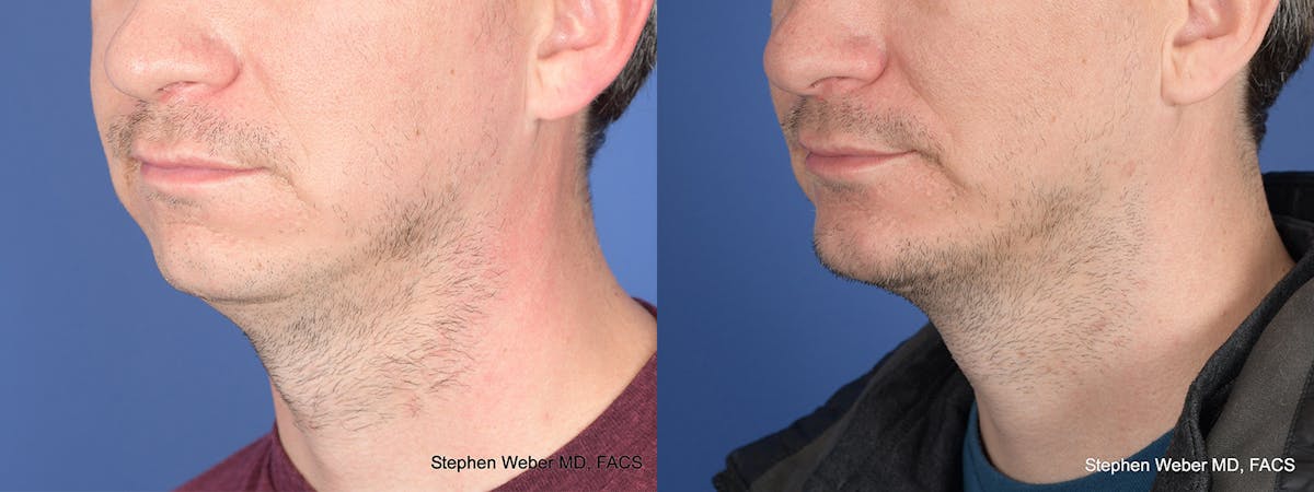 Chin Implant Before & After Gallery - Patient 421135 - Image 3