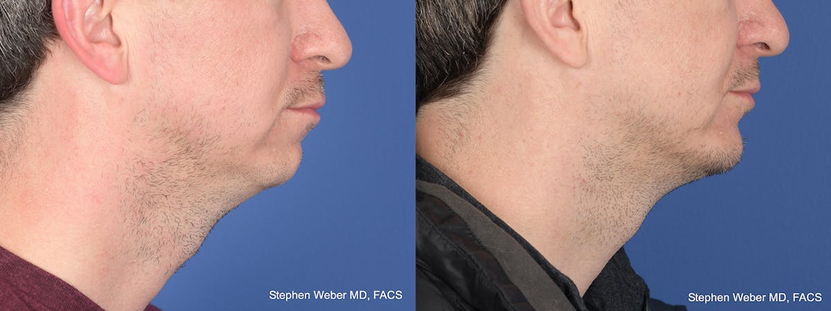 Chin Implant Before & After Gallery - Patient 421135 - Image 4