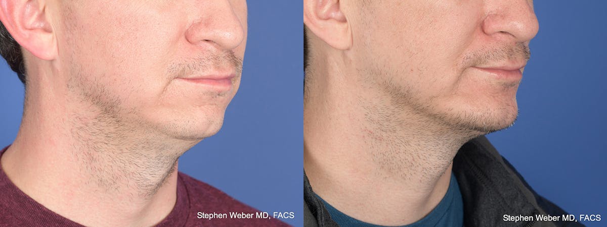 Chin Implant Before & After Gallery - Patient 421135 - Image 5