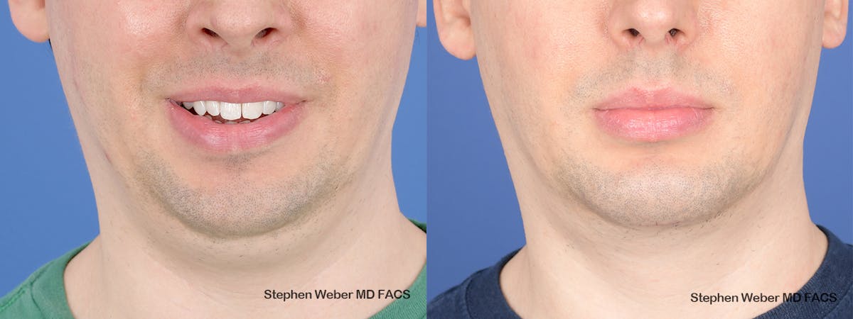 Chin Implant Before & After Gallery - Patient 290274 - Image 1