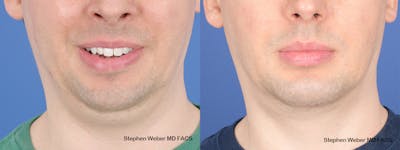 Chin Implant Before & After Gallery - Patient 290274 - Image 1